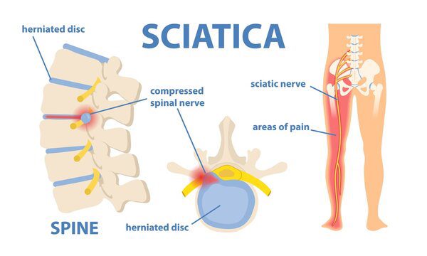 Sciatic Nerve Pain During Pregnancy - Penn Medicine Lancaster General Health